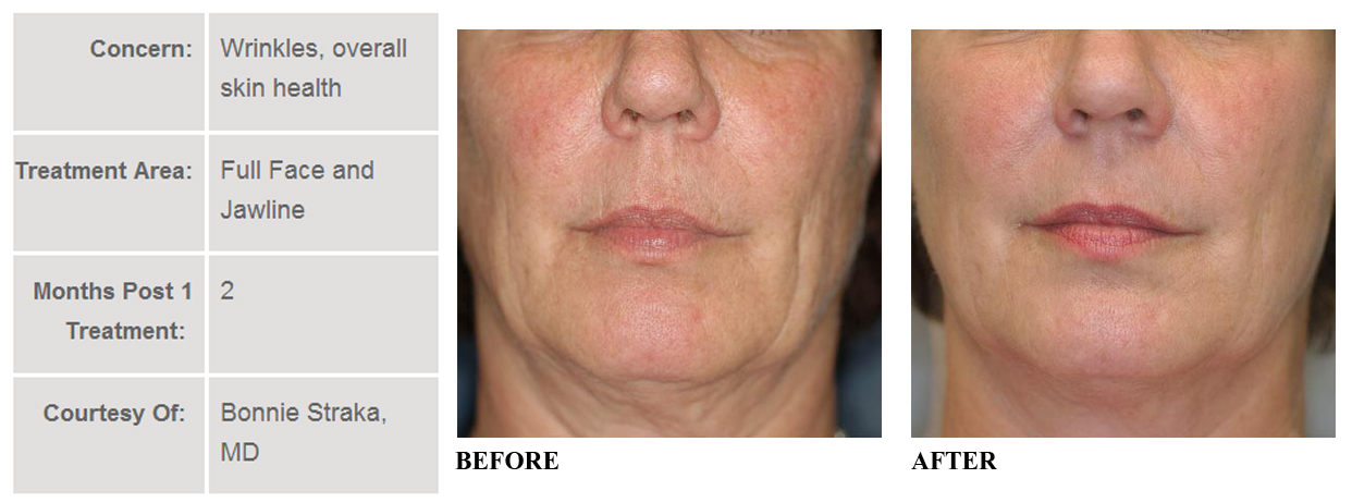 Kết quả hình ảnh cho thermage cpt